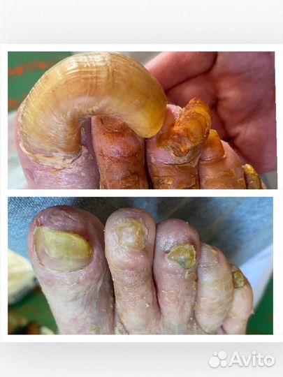 Бородавки.Мозоли.Вросшие ногти.Педикюр.Подолог