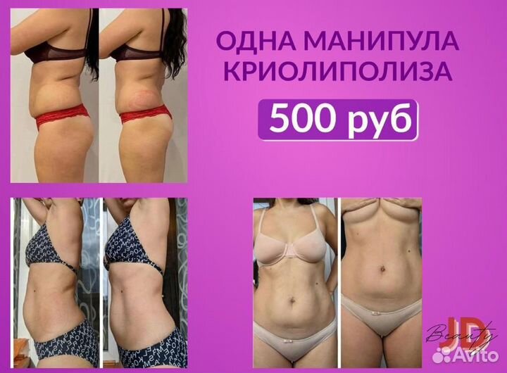 Lpg массаж,криолиполиз,емс,кавитация,rf лифтинг