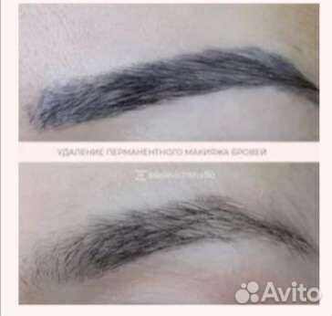 Убираю старое тату. Состав Ревайвинк