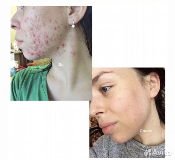 Средство от прыщей/акне/угревой сыпи