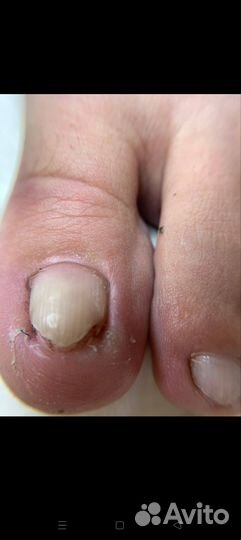 Подолог,вросший ноготь, стержневые мозоли
