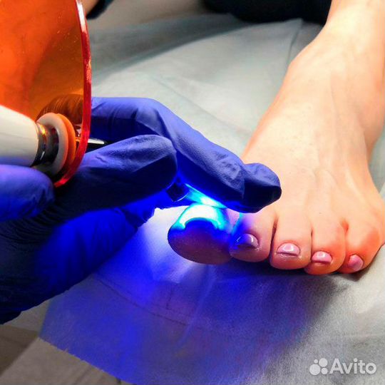 Подолог, установка титановые нити