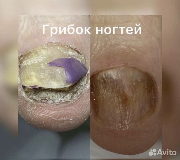 Медицинский педикюр. Подолог
