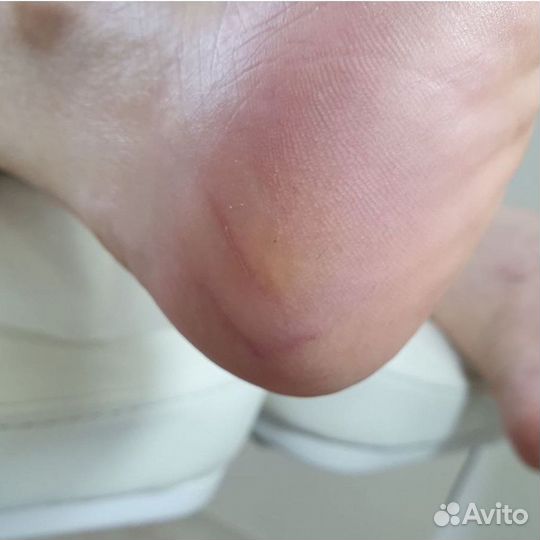 Лечебный педикюр, подолог