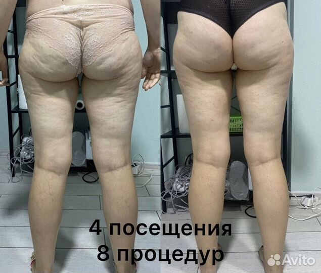 Антицеллюлитный массаж