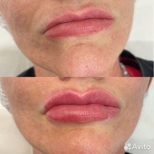 Увелечение губ;Ботулинотерапия