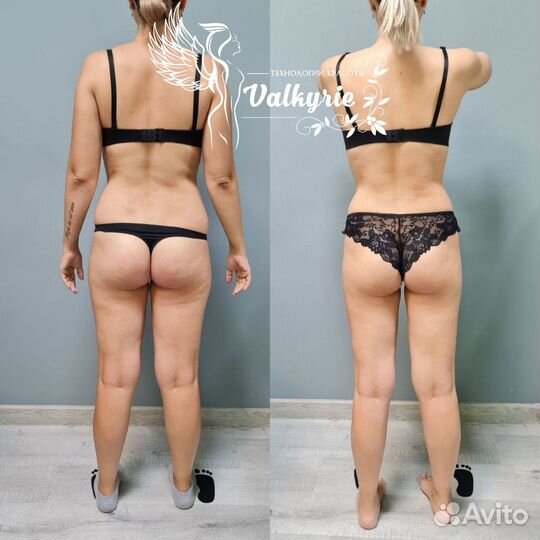 Антицеллюлитный массаж vela shape, LPG, вакуумный