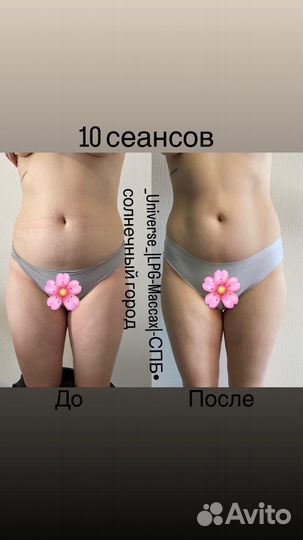 LPG массаж тела и лица. Ручной массаж. Медовый