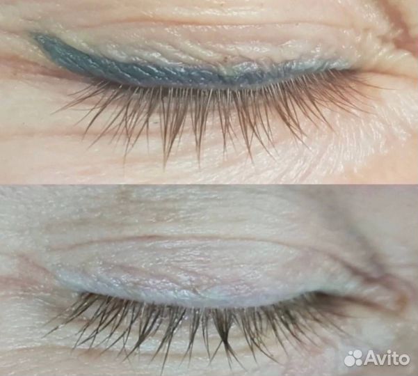 Удаление тату татуажа любых цветов