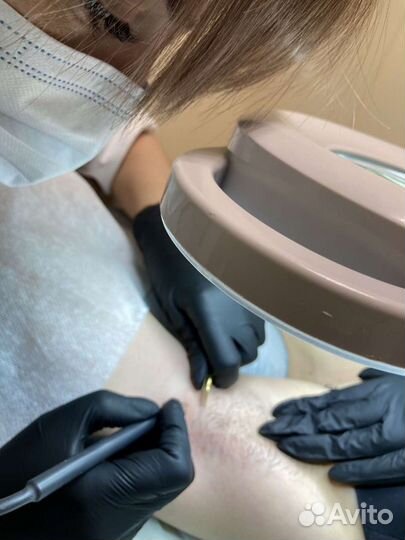 Электроэпиляция, удаление волос навсегда