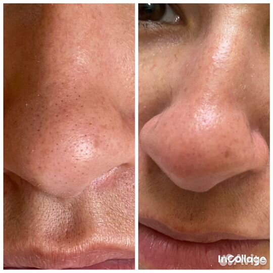 Гидропилинг