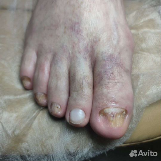 Педикюр подолог