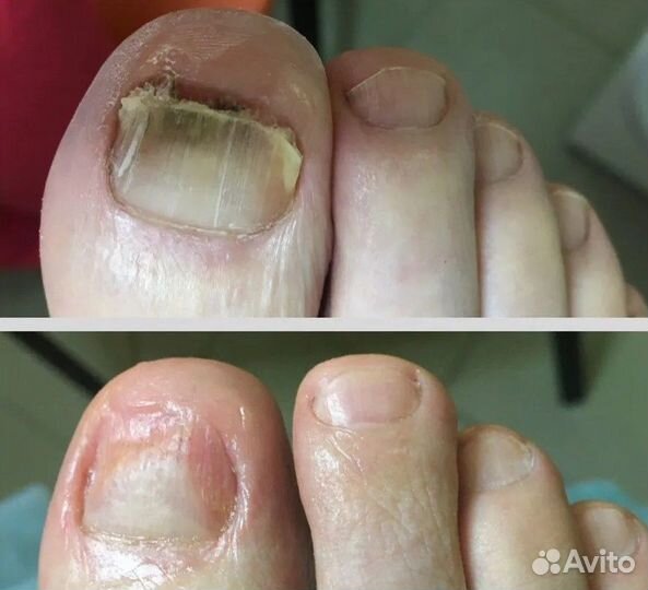 Медицинский педикюр вросший ноготь