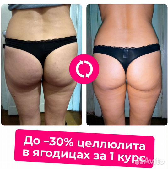 Кавитация. До - 30 целлюлита в ягодицах за курс