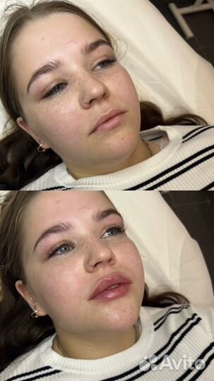 Увеличение губ