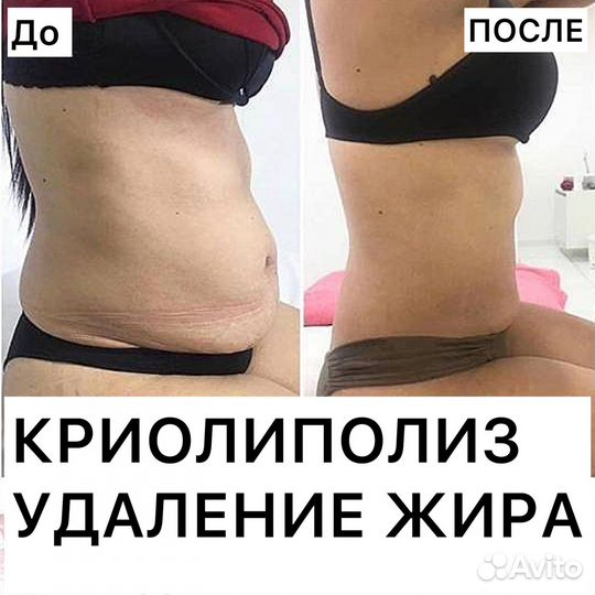 Удаление жира, криолиполиз в ульяновске