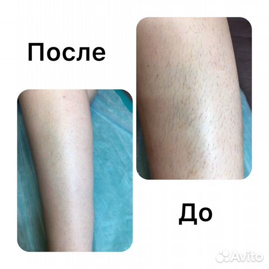Шугаринг, фитосмола