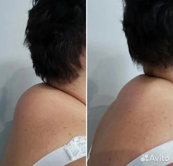 Липолитики