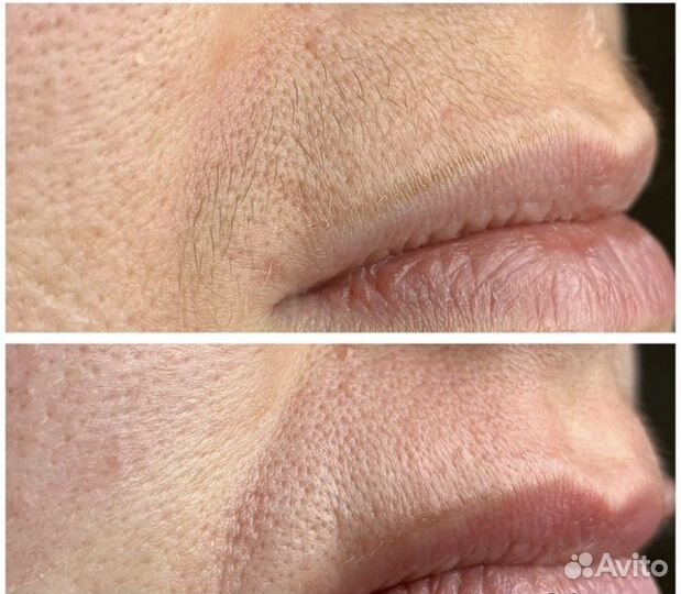 Электроэпиляция