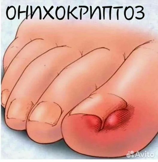 Педикюр. Подолог