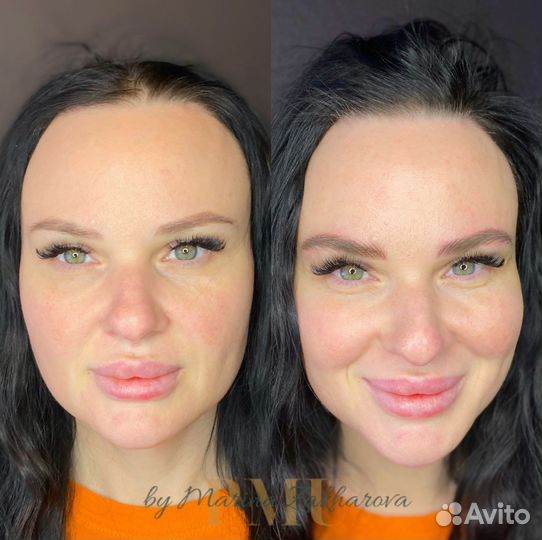 Волосковая техника, удаление пм,татуаж,перекрытие