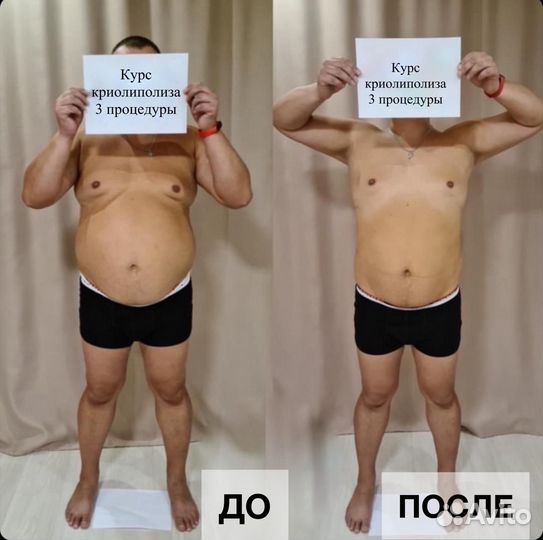 Криолиполиз для мужчин, похудение без операции