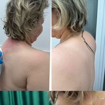 Липосакция. Убрать жир. подбородок, живот, Ставрополь