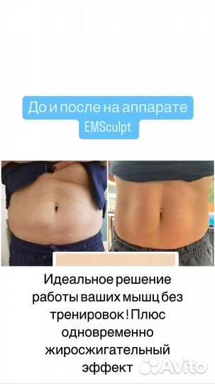 Emsculpt процедура до -3 см за сеанс, похудение