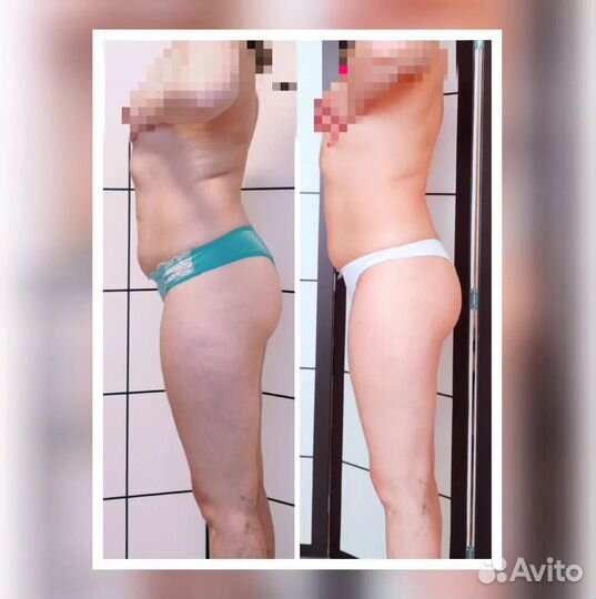 Вакуумно-роликовый массаж тела LPG