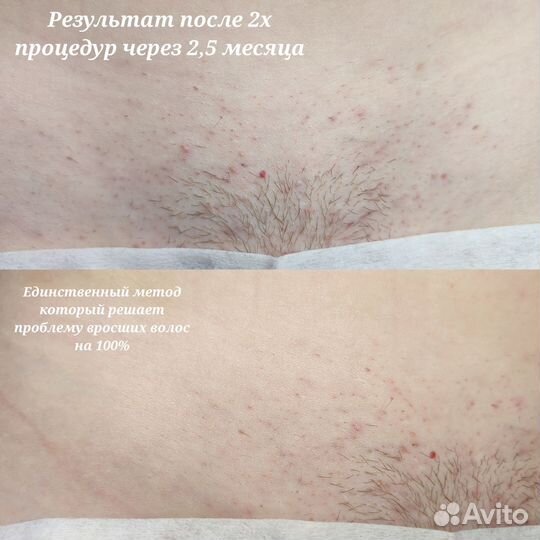 Электроэпиляция Apilus(можно в 4 руки)