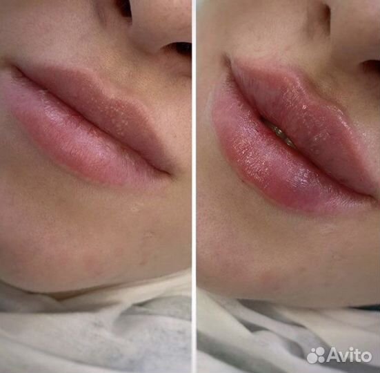 Увеличение губ