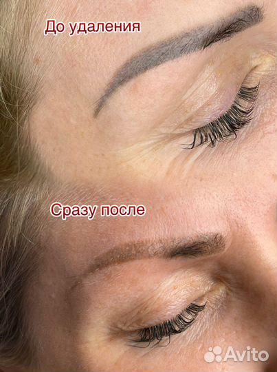 Удаление татуажа лазером