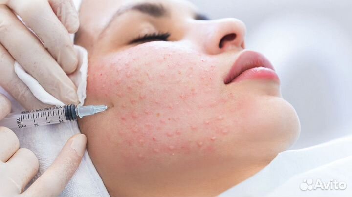 Мезотерапия лица