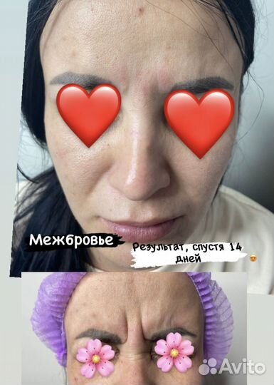 Ботокс.Косметология