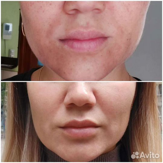 Косметолог, массаж, пилинг, чистка, аппарат массаж