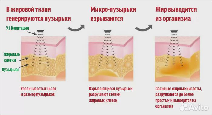 Аппаратная коррекция фигуры