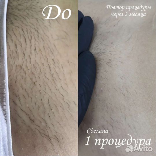 Электроэпиляция