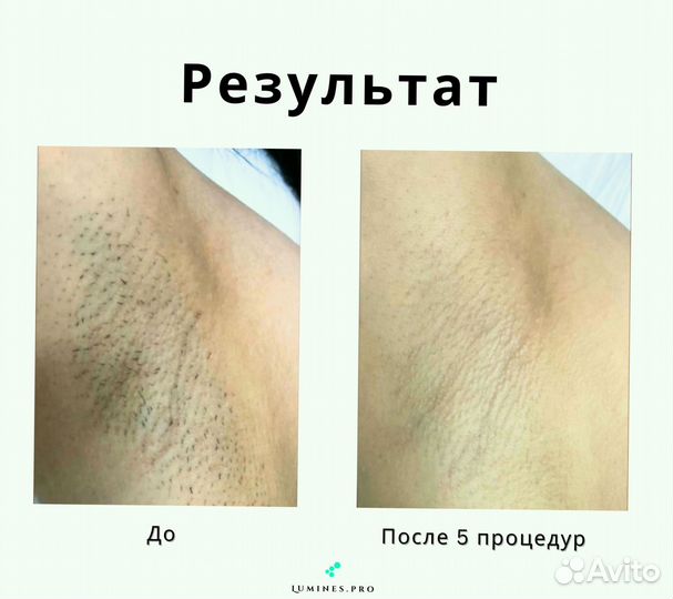 Аппарат для эпиляции Lumines’ Макс-Ван 1200