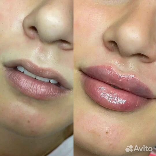 Увеличение губ Коррекция губ Контурная пластика