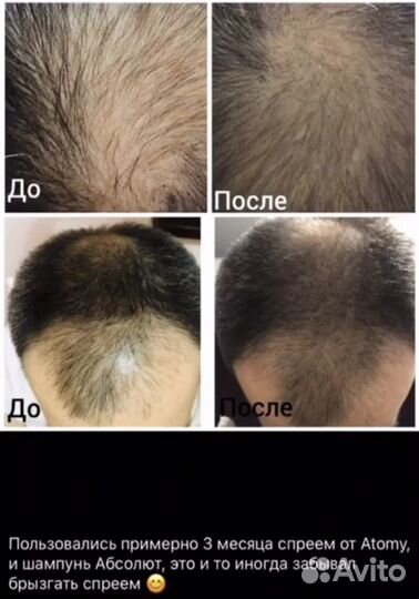 Спрей против выпадения волос Атоми