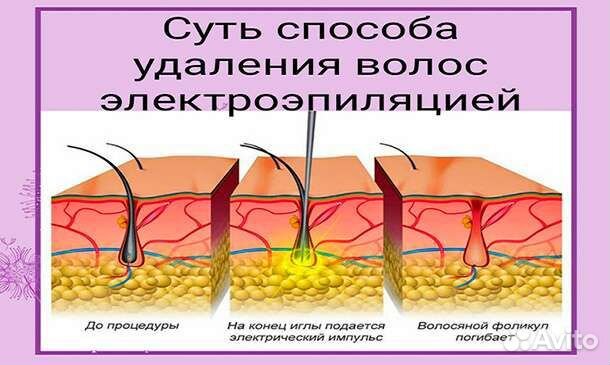 Электроэпиляция(удаление навсегда)