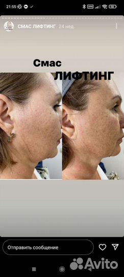 SMAS лифтинг лица