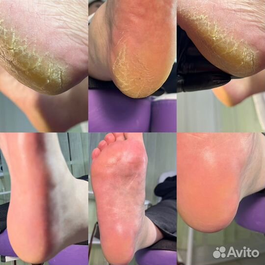 Педикюр (не.мед подолог)