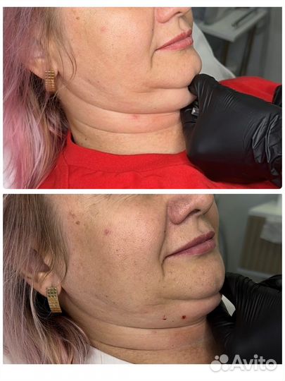 Липолитики для лица