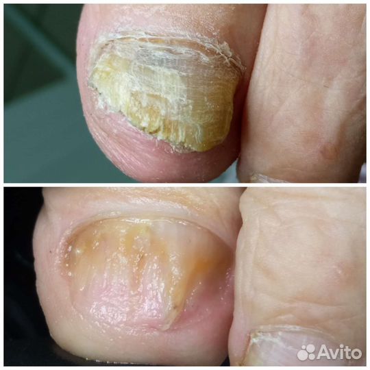 Медицинский педикюр/подолог