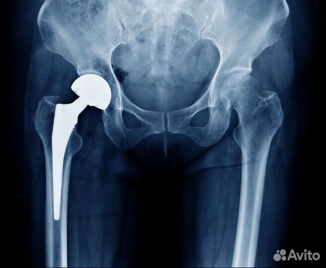 Пассивная реабилитация/пассивное восстановление