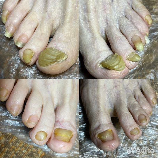 Подолог, медицинский педикюр