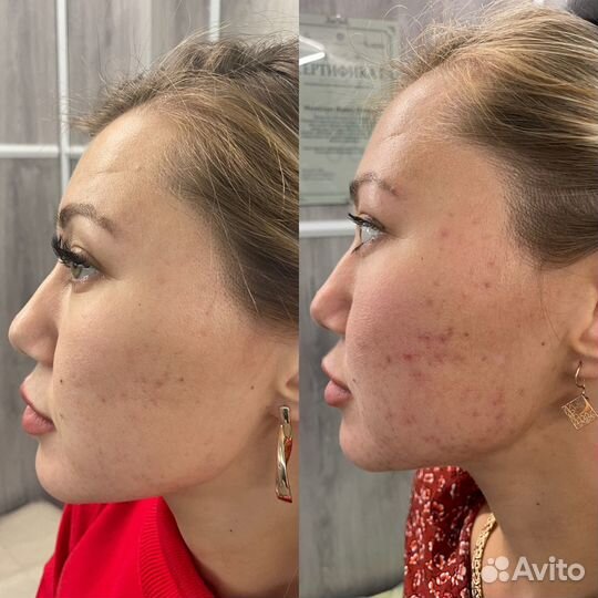 Холодная плазма, омоложение, лечение целлюлита