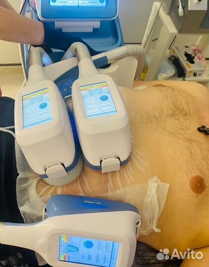 Криолиполиз похудение липосакция для мужчин