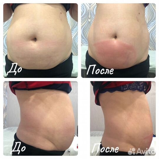 Криолиполиз + миостимуляция